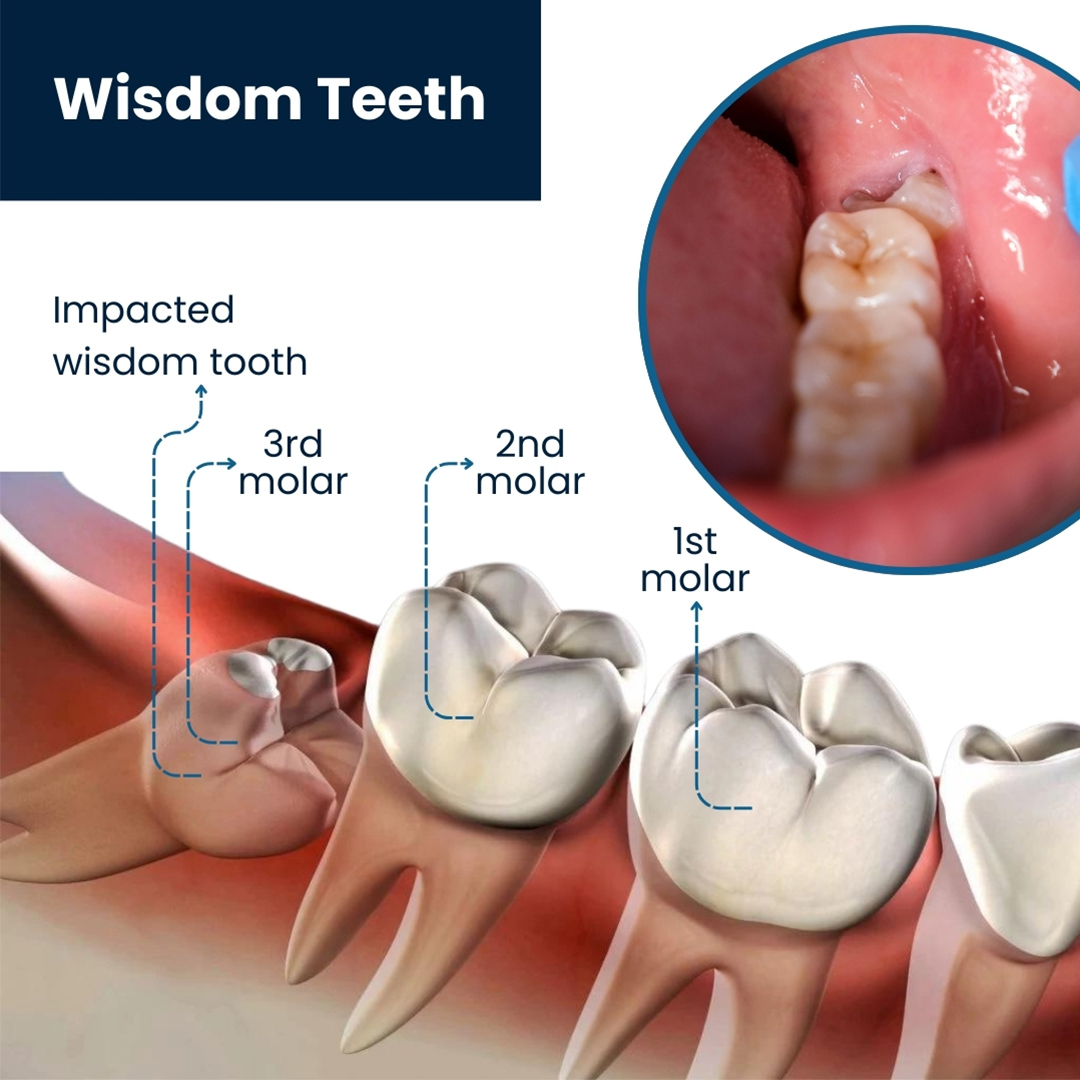 Wisdom teeth removal illustration