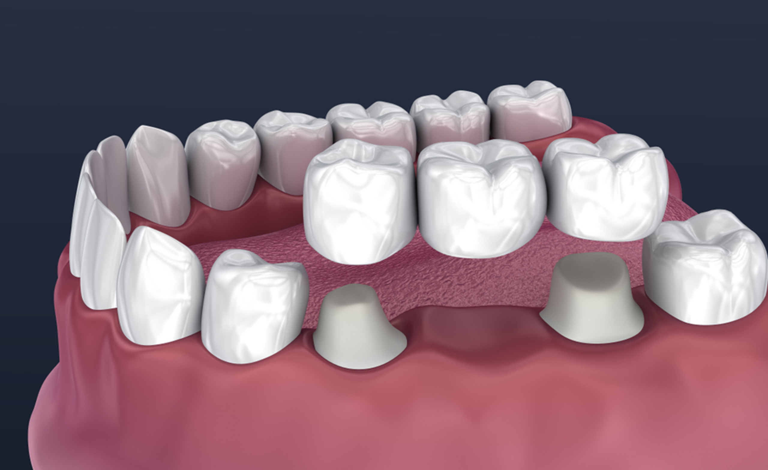 Dental bridges and crowns illustration