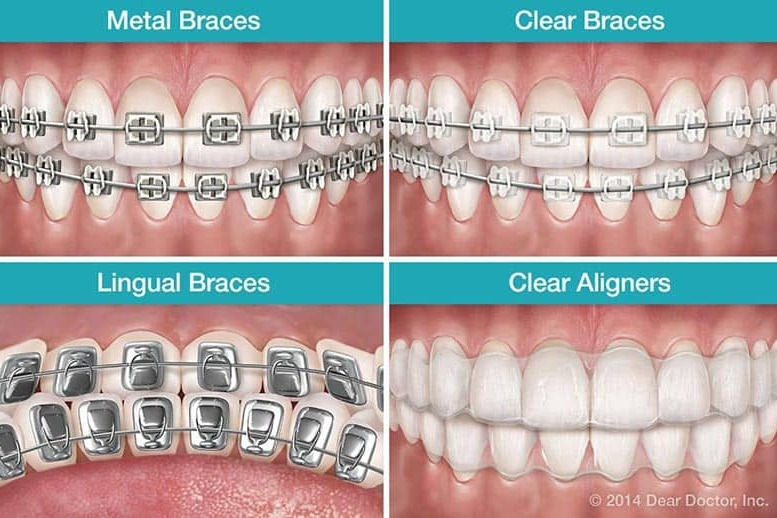 Dental braces illustration