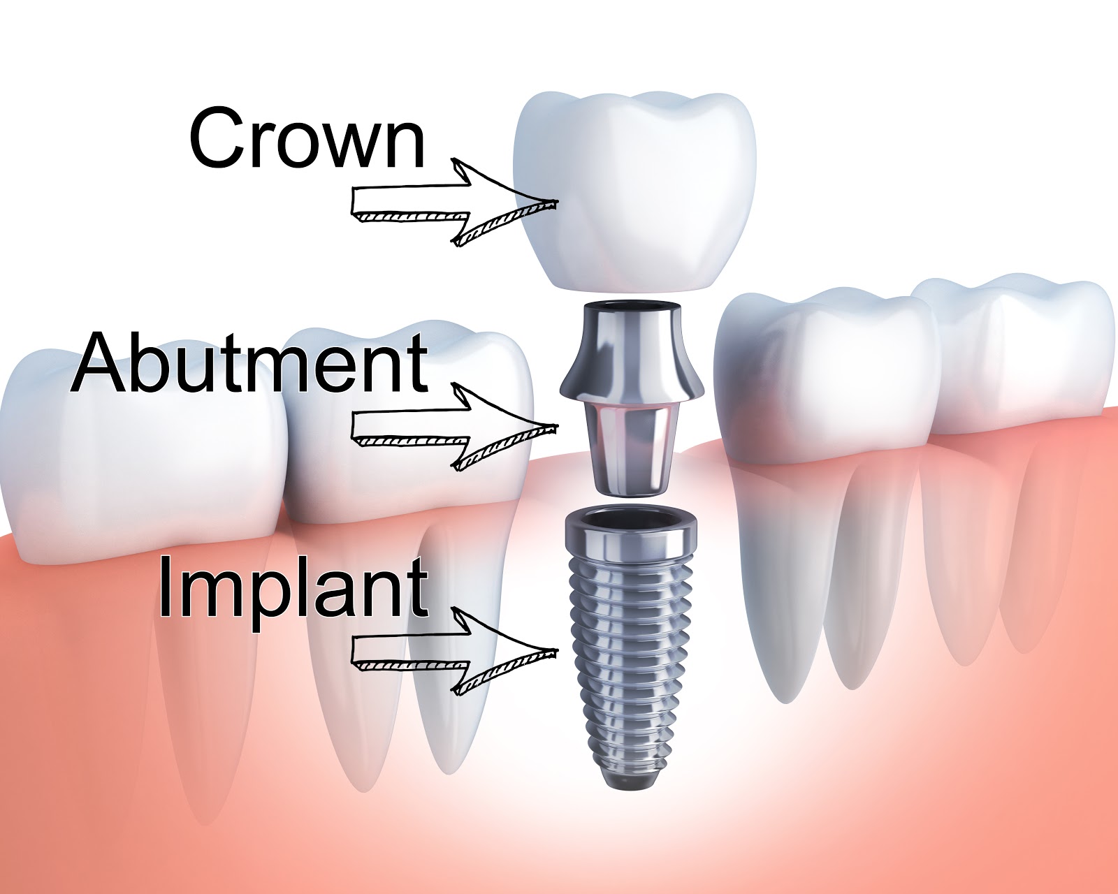 Dental implants illustration