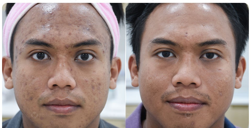 Laser dental treatment illustration