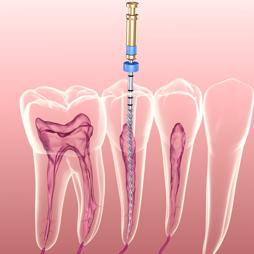 Root canal treatment illustration